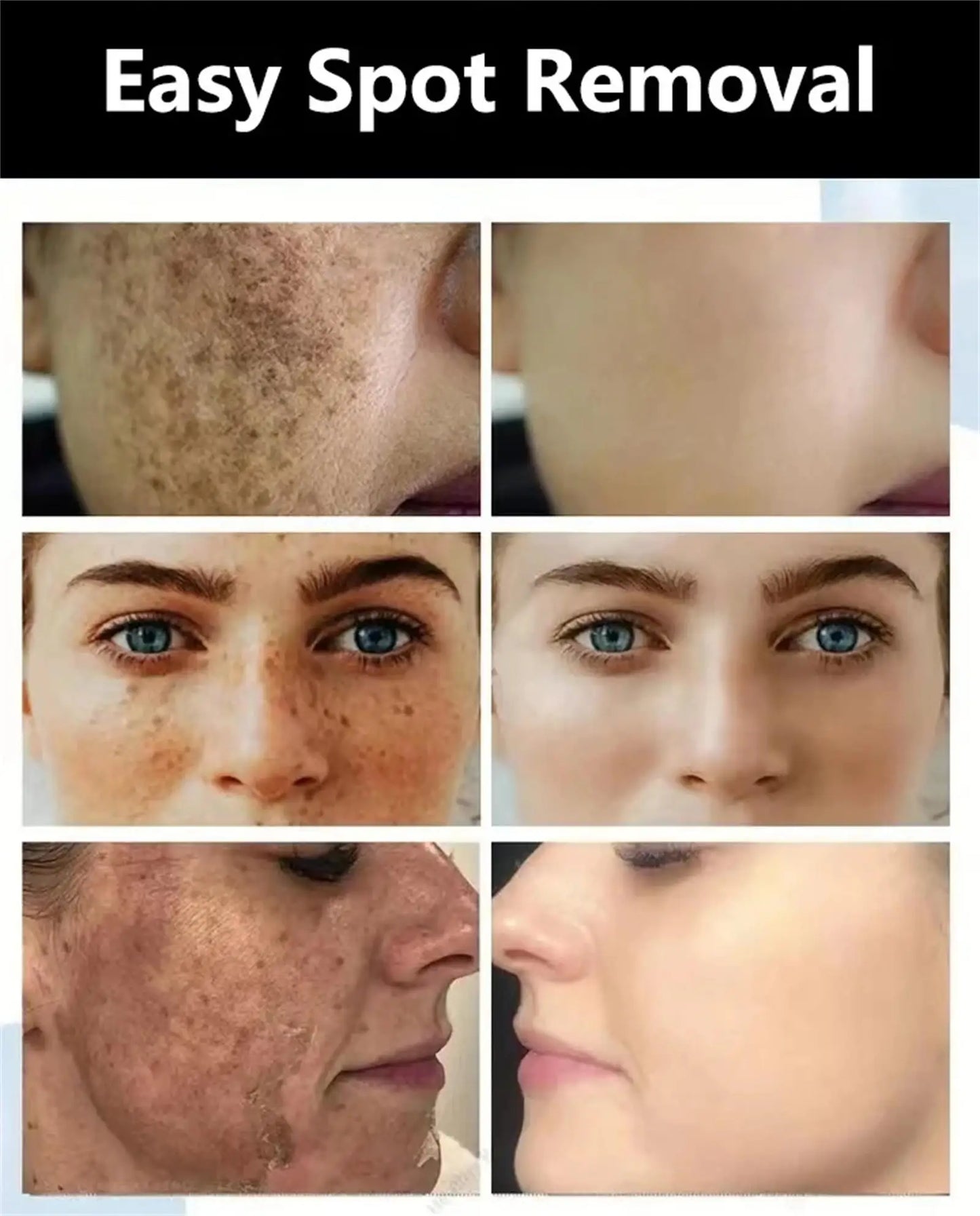 Powerful Dark Spots Remover Whitening Serum Face Freckle Melanin Correcting Anti Pigmentation Brighten Skin Beauty Care Products