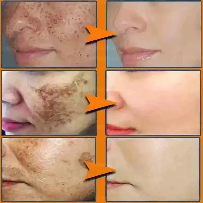 Whitening Freckles Face Cream Removal Melasma Dark Spots Corrector Lighten Melanin Pigmentation Brighten Anti-Aging Beauty Care