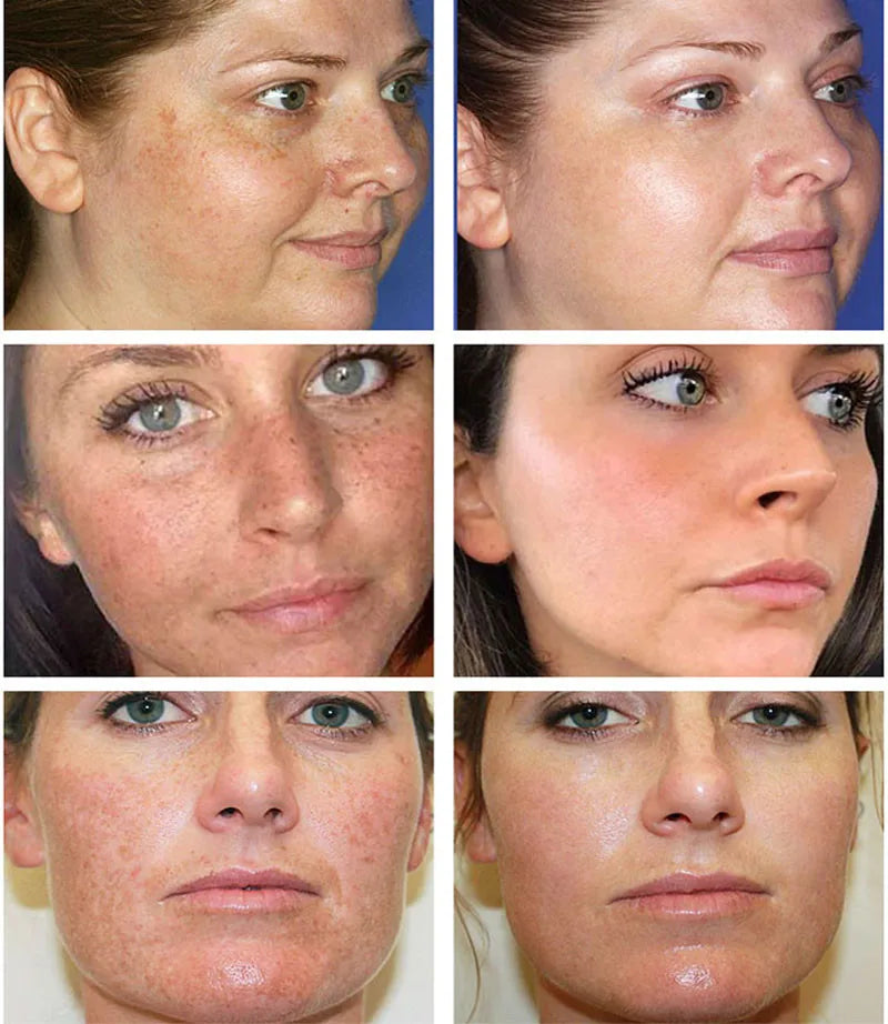 Powerful Dark Spots Remover Whitening Serum Face Freckle Melanin Correcting Anti Pigmentation Brighten Skin Beauty Care Products