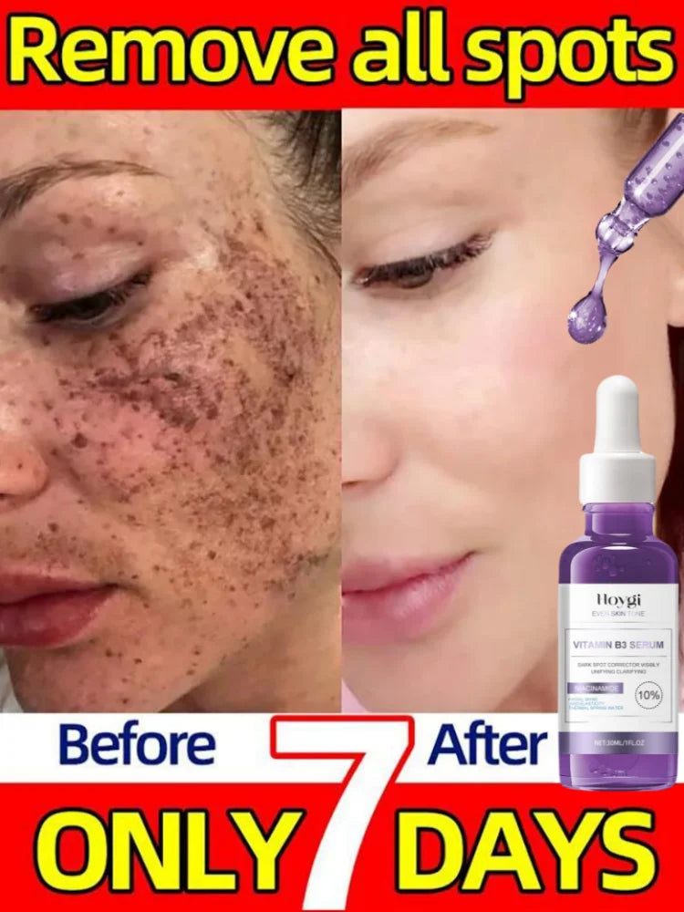 Powerful Dark Spots Remover Whitening Serum Face Freckle Melanin Correcting Anti Pigmentation Brighten Skin Beauty Care Products