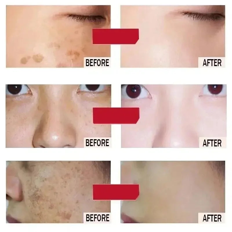 Whitening Freckles Face Cream Removal Melasma Dark Spots Corrector Lighten Melanin Pigmentation Brighten Anti-Aging Beauty Care