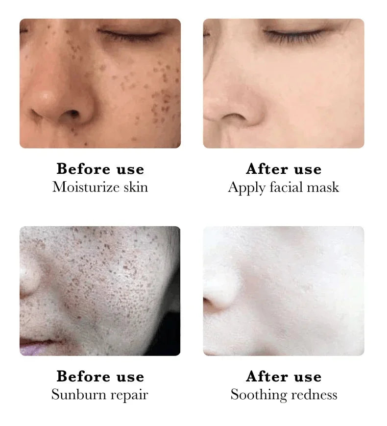 Whitening Freckles Face Cream Removal Melasma Dark Spots Corrector Lighten Melanin Pigmentation Brighten Anti-Aging Beauty Care