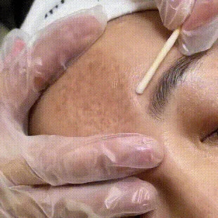 Whitening Freckles Face Cream Removal Melasma Dark Spots Corrector Lighten Melanin Pigmentation Brighten Anti-Aging Beauty Care