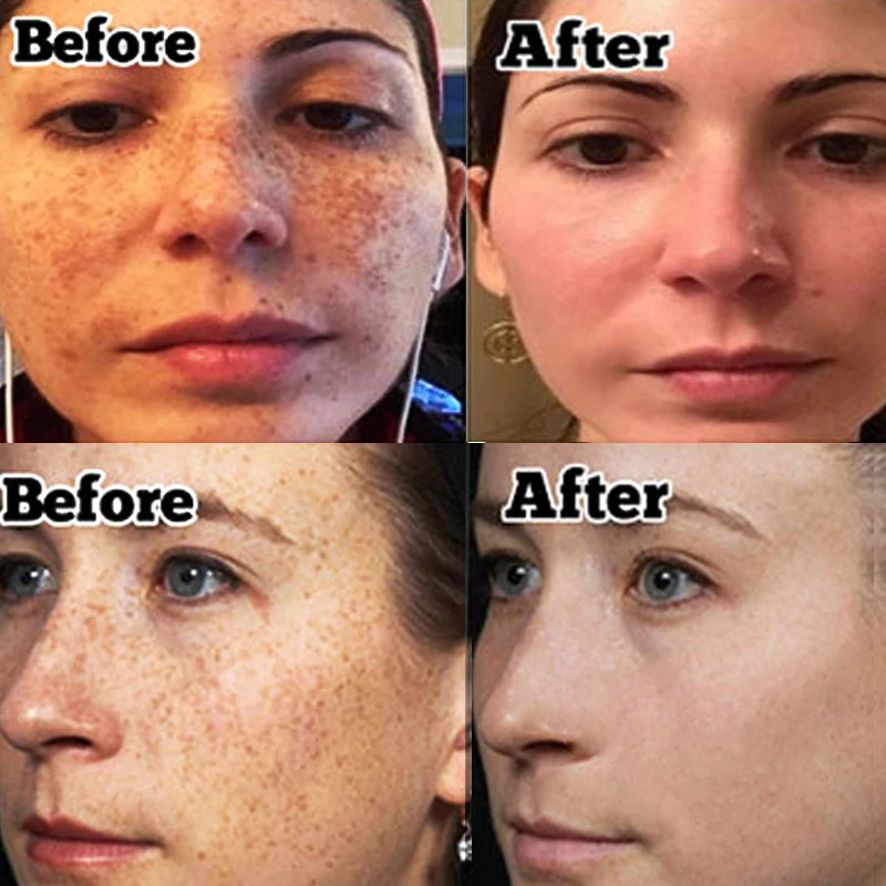 Powerful Dark Spots Remover Whitening Serum Face Freckle Melanin Correcting Anti Pigmentation Brighten Skin Beauty Care Products