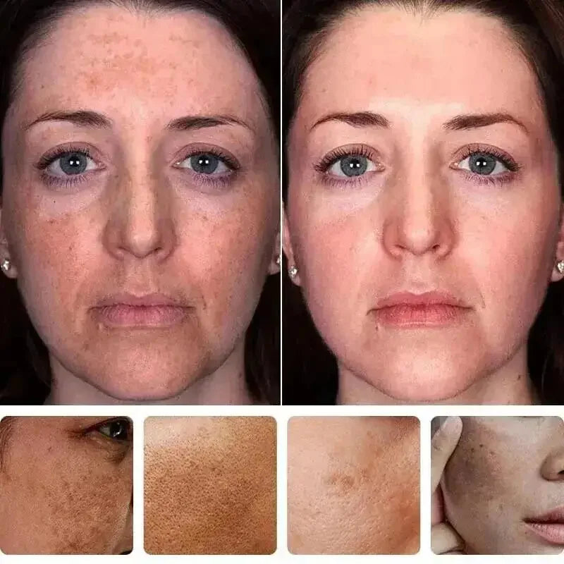 Whitening Freckles Face Cream Removal Melasma Dark Spots Corrector Lighten Melanin Pigmentation Brighten Anti-Aging Beauty Care